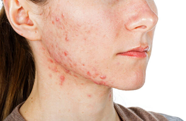 What is Jawline Acne?